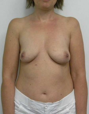 Breast Augmentation Case 5080 Before Photo Breast Augmentation