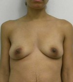 Breast Augmentation