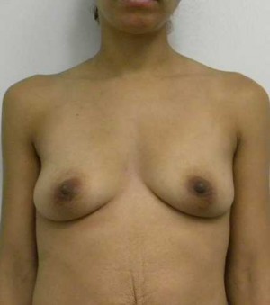 Breast Augmentation Case 5087 Before Photo Breast Augmentation