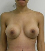 Breast Augmentation