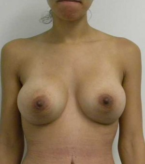 Breast Augmentation Case 5087 After Photo Breast Augmentation