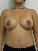 Breast Augmentation