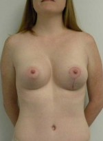 Breast Augmentation