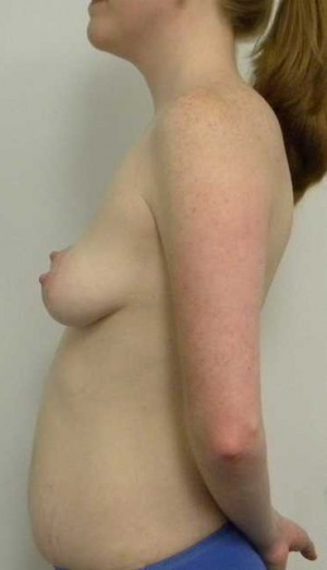 Breast Augmentation Case 5101 Before Photo Breast Augmentation