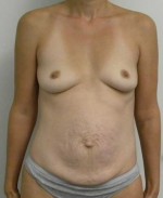 Breast Augmentation