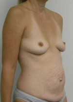 Breast Augmentation