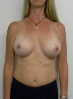 Breast Augmentation