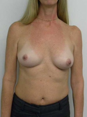 Breast Augmentation Case 5115 Before Photo Breast Augmentation