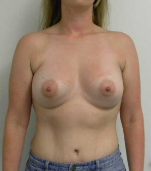 Breast Augmentation