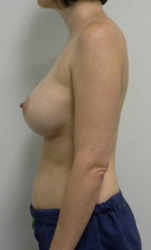 Breast Augmentation