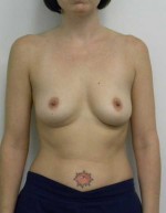 Breast Augmentation