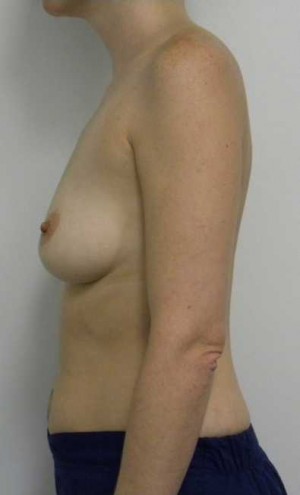 Breast Augmentation