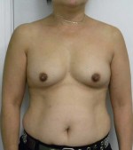 Breast Augmentation
