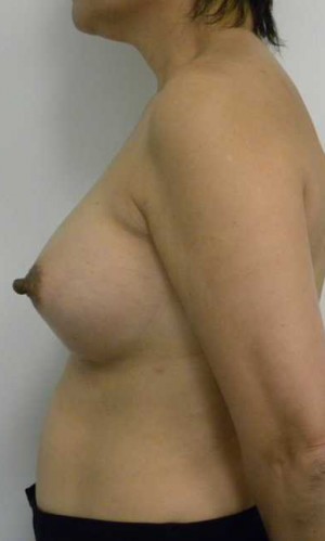 Breast Augmentation Case 5136 After Photo Breast Augmentation