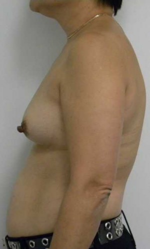 Breast Augmentation Case 5136 Before Photo Breast Augmentation