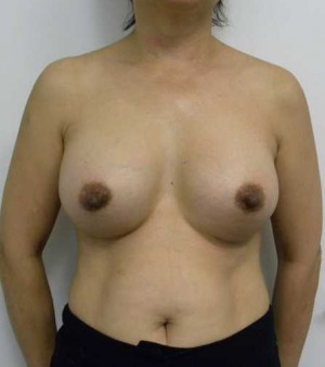 Breast Augmentation Case 5136 After Photo Breast Augmentation