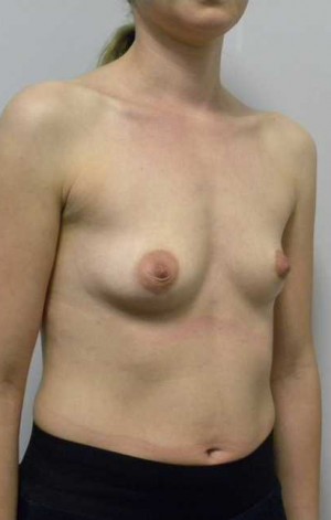 Breast Augmentation Case 5143 Before Photo Breast Augmentation