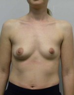 Breast Augmentation