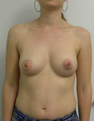 Breast Augmentation Case 5143 After Photo Breast Augmentation