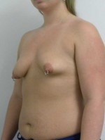 Breast Augmentation