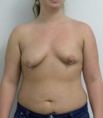 Breast Augmentation