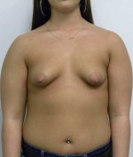Breast Augmentation