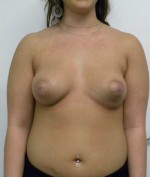 Breast Augmentation