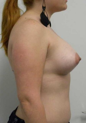 Breast Augmentation Case 5171 After Photo Breast Augmentation