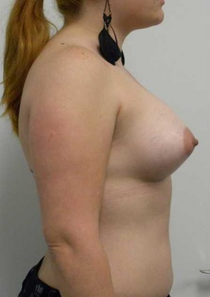 Breast Augmentation