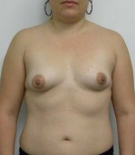 Breast Augmentation