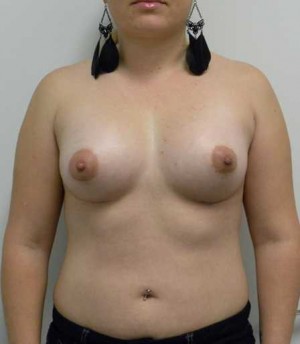 Breast Augmentation Case 5171 After Photo Breast Augmentation