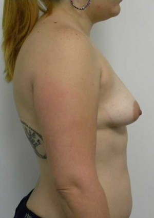 Breast Augmentation Case 5171 Before Photo Breast Augmentation