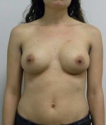 Breast Augmentation