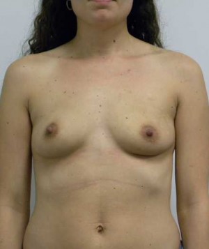 Breast Augmentation Case 5178 Before Photo Breast Augmentation