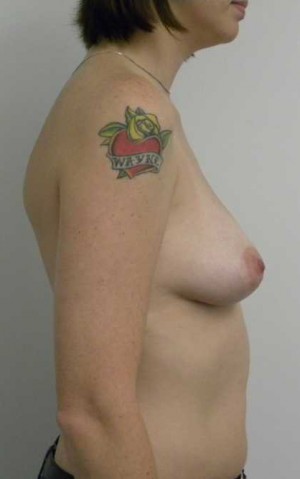 Breast Augmentation Case 5185 Before Photo Breast Augmentation