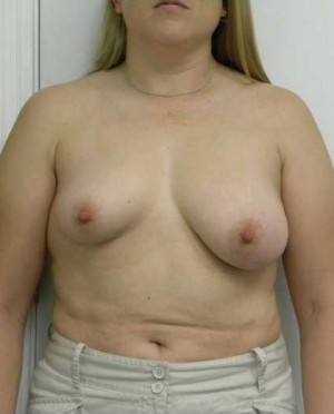 Breast Augmentation Case 5192 Before Photo Breast Augmentation
