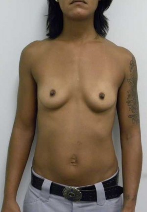 Breast Augmentation Case 5199 Before Photo Breast Augmentation