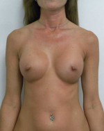 Breast Augmentation
