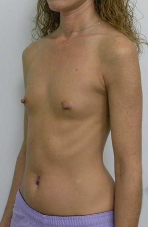 Breast Augmentation Case 5206 Before Photo Breast Augmentation