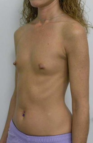 Breast Augmentation