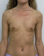Breast Augmentation