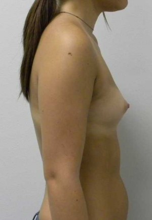Breast Augmentation Case 5213 Before Photo Breast Augmentation