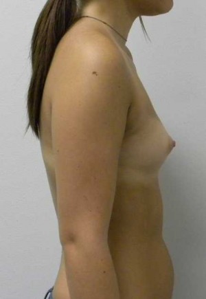 Breast Augmentation