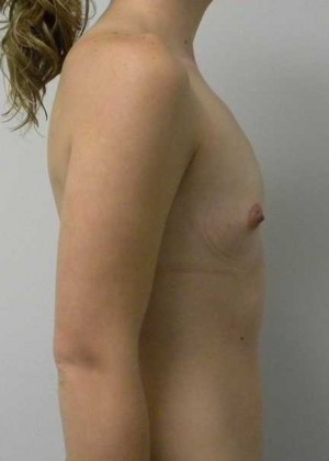 Breast Augmentation Case 5220 Before Photo Breast Augmentation