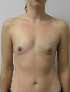 Breast Augmentation Case 5220 Before Photo Breast Augmentation