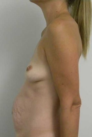 Breast Augmentation Case 5227 Before Photo Breast Augmentation