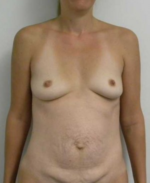 Breast Augmentation Case 5227 Before Photo Breast Augmentation