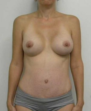 Breast Augmentation Case 5227 After Photo Breast Augmentation