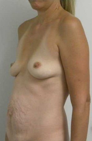 Breast Augmentation Case 5227 Before Photo Breast Augmentation