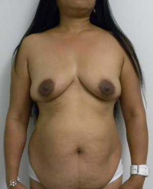 Breast Augmentation Case 5234 Before Photo Breast Augmentation